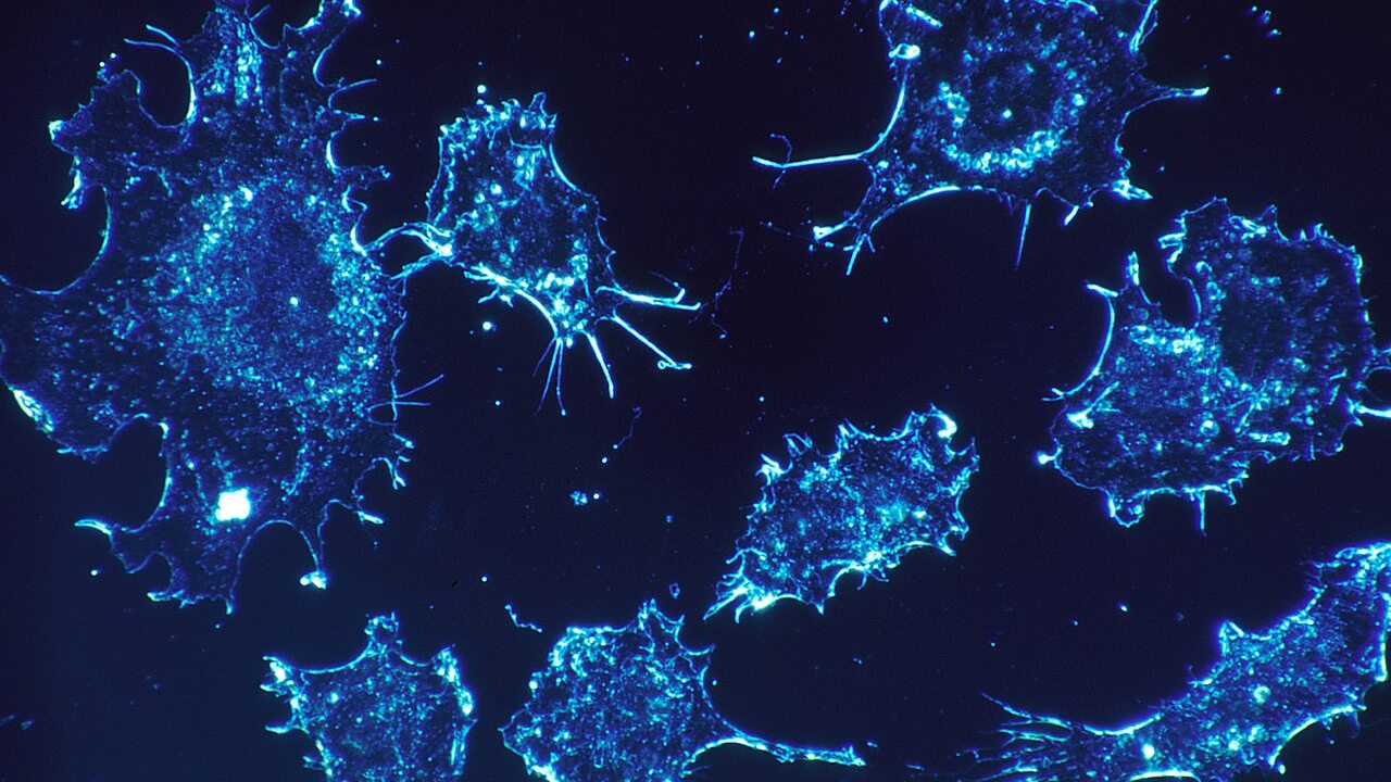Cancer cells in laboratory culture viewed with amplified contrast microscopy.